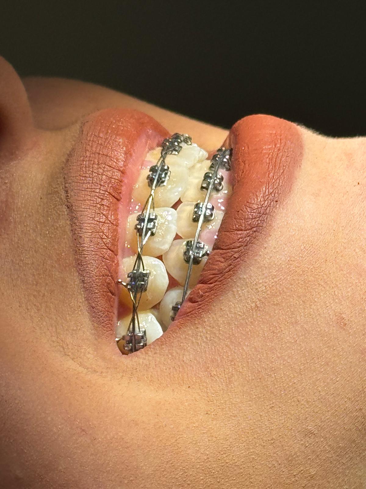 Brackets modernos